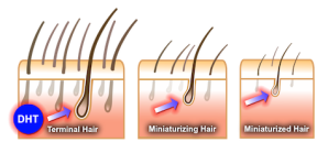 The substance that attacks hair follicles and leads to hair loss. Image from hairloss.org.