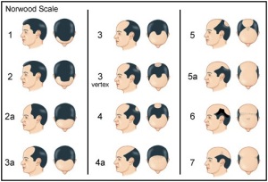 The stages of hair loss in men. Image from www.evolvehairclinic.com.