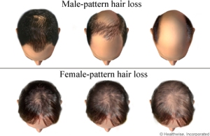 This section corresponds to the middle stage in the above diagram for male-pattern hair loss.  You have lost a substantial amount of hair, but there is still some on the top.  Image from www.theprivateclinic.co.uk.