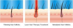 Some treatments such as low-level lasers may stimulate hair growth. Image from www.irestorehairlaser.com.